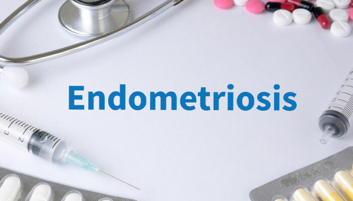 Endometriosis – Symptoms and natural remedies