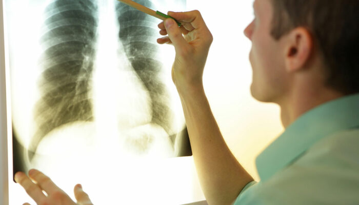 MAC lung disease – 8 common signs and management options